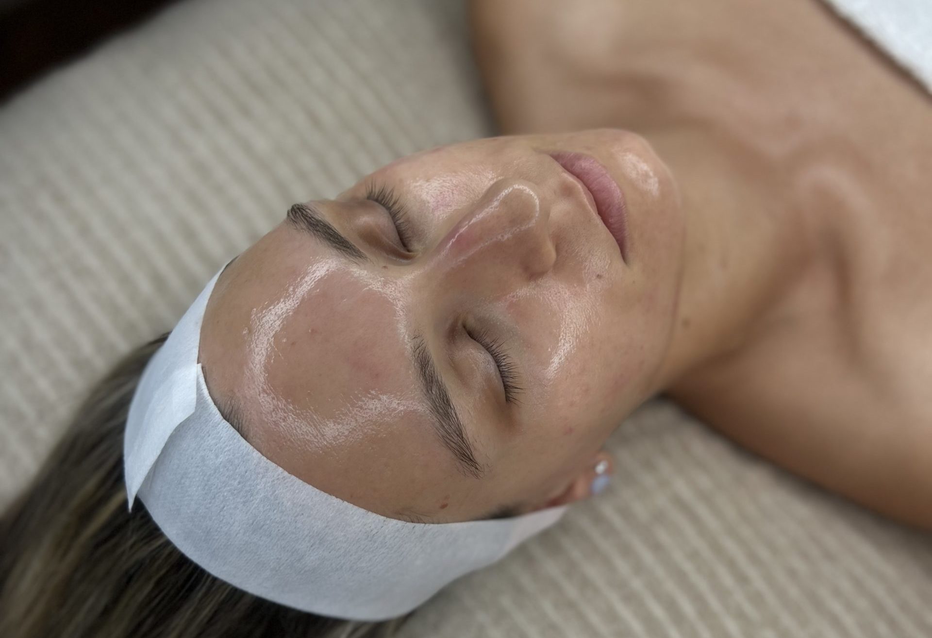 Chemisches Peeling