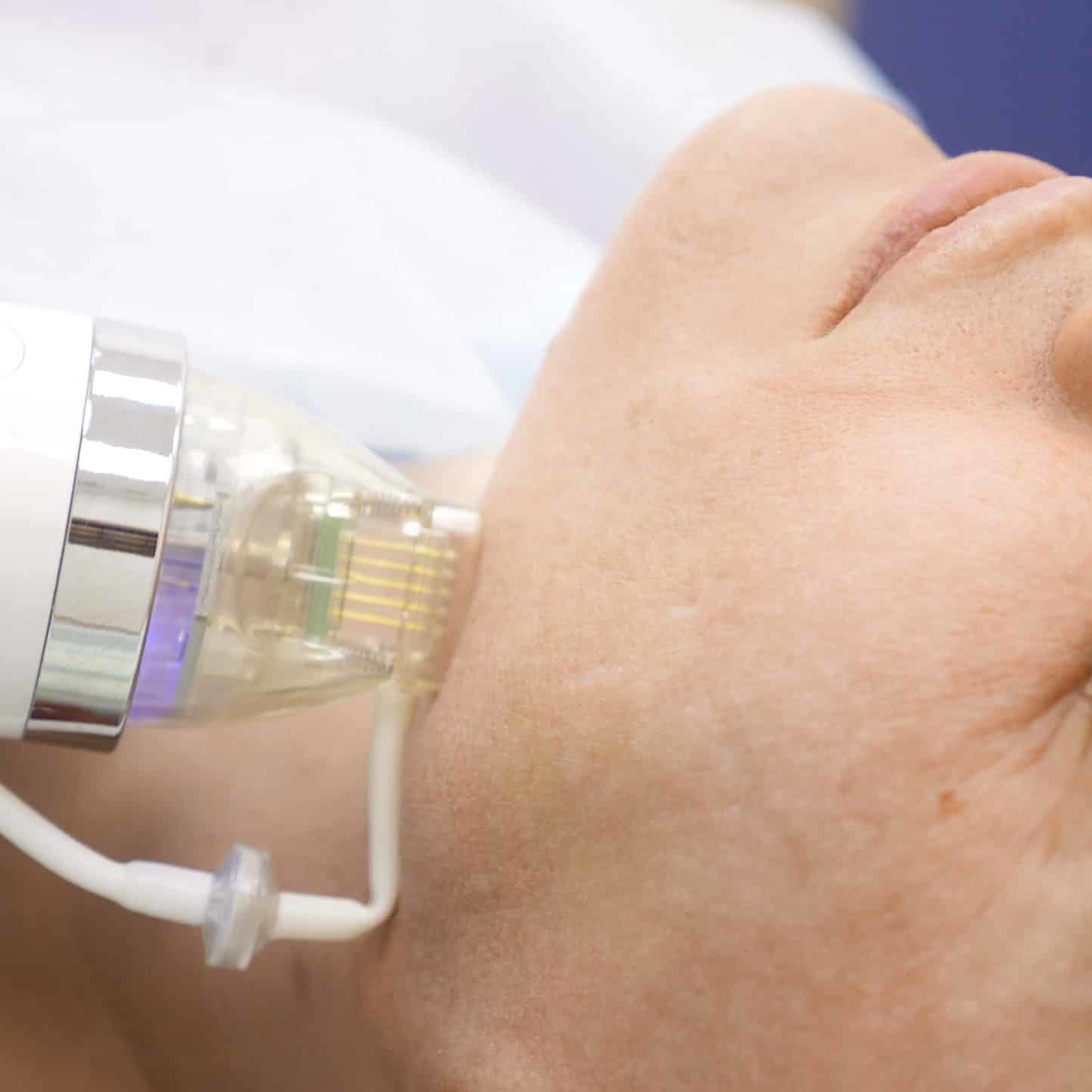 Radiofrequenz Microneedling