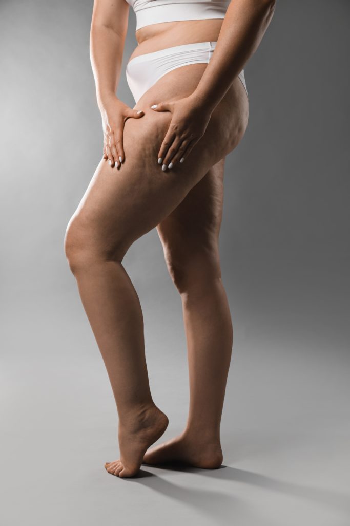 Cellulite Behandlung Wien